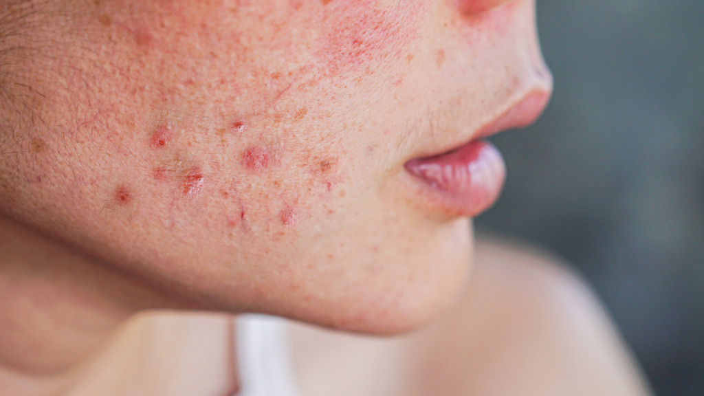 Close de pele sensível com tendência a acne mostrando áreas inflamadas e vermelhidão, exemplificando a importância de cuidados adequados para tratar e acalmar a pele delicada